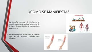 Distrofia muscular de duchenne | PPTX