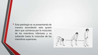 Distrofia muscular de duchenne | PPTX