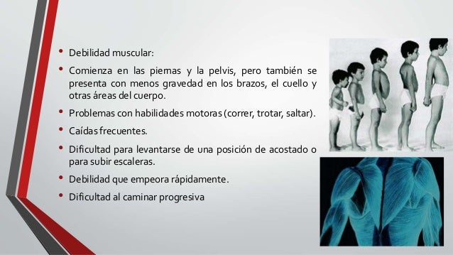 Distrofia muscular de duchenne Distrofia muscular de duchenne