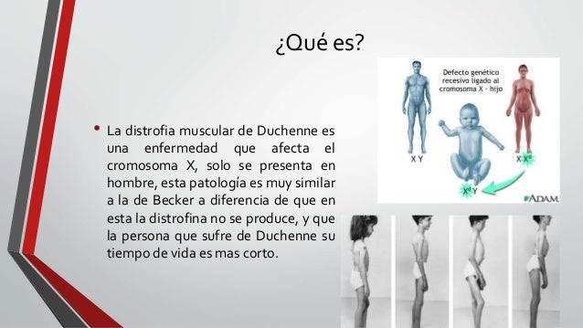 Distrofia muscular de duchenne Distrofia muscular de duchenne