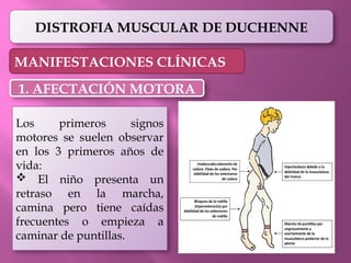 DISTROFIA MUSCULAR DE DUCHENNE EN PEDIATRIA | PPTX