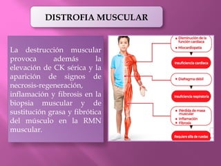 DISTROFIA MUSCULAR DE DUCHENNE EN PEDIATRIA | PPTX