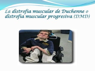 Distrofia muscular de duchenne (dmd) | PPTX