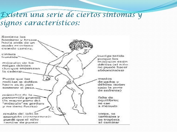 Distrofia muscular de duchenne (dmd) Distrofia muscular de duchenne (dmd)