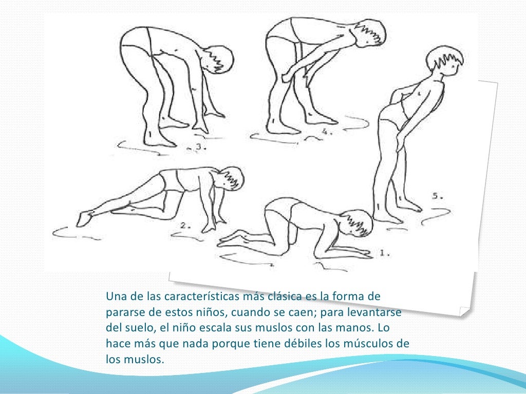 Distrofia muscular de duchenne (dmd)
