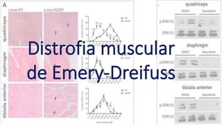 Distrofia muscular
de Emery-Dreifuss
 