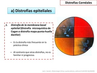 Distrofias Cornéales

     a) Distrofias epiteliales


1.   Distrofia de la membrana basal
     epitelial (Distrofia microquística de
     Cogan o distrofia mapa-punto-huella
     dactilar)

     – Es la distrofia más frecuente en la
       práctica clínica

     – Al contrario que otras distrofias, no es
       familiar ni progresiva.




                                      Jack J. kanski: oftalmología clínica; quinta edición; editorial ELSEVIER SAUNDERS
 