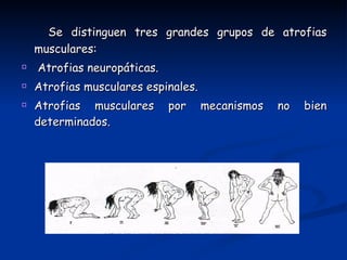 <ul><li>Se distinguen tres grandes grupos de atrofias musculares: </li></ul><ul><li>Atrofias neuropáticas. </li></ul><ul><...