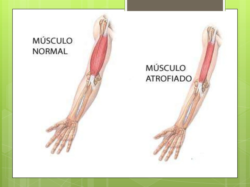 Distrofias musculares