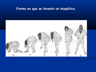 Forma en que se levanta un miopático.
 