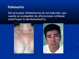 Polimiositis
Son procesos inflamatorios de los músculos, que
cuando se acompañan de alteraciones cutáneas
constituyen la dermatomiositis.
 
