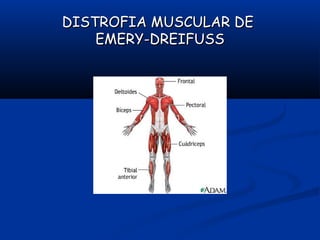 DISTROFIA MUSCULAR DEDISTROFIA MUSCULAR DE
EMERY-DREIFUSSEMERY-DREIFUSS
 