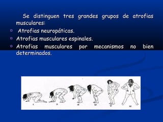 Se distinguen tres grandes grupos de atrofiasSe distinguen tres grandes grupos de atrofias
musculares:musculares:
Atrofias neuropáticas.Atrofias neuropáticas.
Atrofias musculares espinales.Atrofias musculares espinales.
Atrofias musculares por mecanismos no bienAtrofias musculares por mecanismos no bien
determinados.determinados.
 