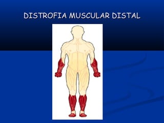 DISTROFIA MUSCULAR DISTALDISTROFIA MUSCULAR DISTAL
 