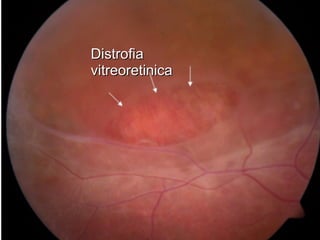DistrofiaDistrofia
vitreoretinicavitreoretinica
 