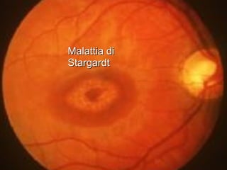 Malattia diMalattia di
StargardtStargardt
 