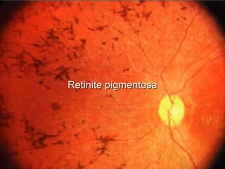 Retinite pigmentosaRetinite pigmentosa
 