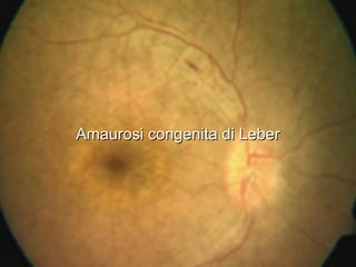 AmaurosiAmaurosi congenita di Lebercongenita di Leber
 