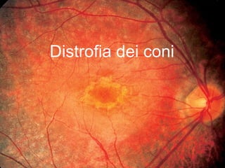 Distrofia dei coni
 