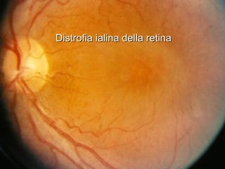 Distrofia ialina della retinaDistrofia ialina della retina
 