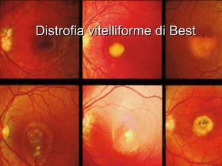 Distrofia vitelliforme di BestDistrofia vitelliforme di Best
 