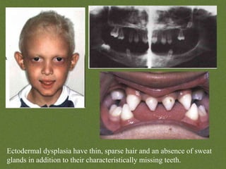 Sparse Teeth Disturbances of dental development | PPTX