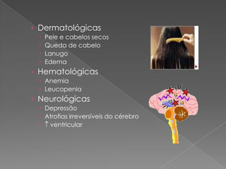› Dermatológicas
    Pele e cabelos secos
    Queda de cabelo
    Lanugo
    Edema
› Hematológicas
  Anemia
  Leucopenia
› Neurológicas
  Depressão
  Atrofias irreversíveis do cérebro
  ventricular
 