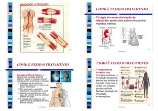 COMO É FEITO O TRATAMENTO

                                                    n   Cirurgia de revascularização do
                                                        miocárdio: ponte (veia safena e/ou artéria
                                                        mamária interna).




                                               13                                                    14
                             www.bioloja.com                                     www.bioloja.com




    COMO É FEITO O TRATAMENTO                           COMO É FEITO O TRATAMENTO
                                                    n   Transplante de
                                                        coração: nas
n   Coração artificial elétrico: o                      cirurgias cardíacas, a
    Heartmate, coração artificial                       circulação sangüínea
    elétrico, ajuda o coração natural
    enfraquecido a bombear o sangue.                    precisa ser isolada do
    Ø O sangue sai do ventrículo                        coração. Para isso, é
      esquerdo, entra em um cano e vai                  usado um coração-
      para o Heartmate.
    Ø Por outro cano, o aparelho                        pulmão artificial,
      impulsiona o sangue para a aorta.                 também chamado de
    Ø O sistema é acionado por uma                      circulação
      caixa de controle que fica na parte
      externa do corpo.                                 extracorpórea.
    Ø A energia é fornecida por uma
      bateria elétrica carregada em uma
      bolsa a tiracolo.
                                               15                                                    16
                             www.bioloja.com                                     www.bioloja.com
 