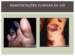 MANIFESTAÇÕES CLINICAS DA CID
 