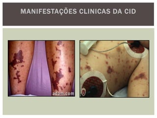 MANIFESTAÇÕES CLINICAS DA CID
 