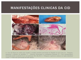 MANIFESTAÇÕES CLINICAS DA CID




A– Foco de fratura de costela (seta vazada) e exsudato purulento proveniente do flegmão no local (seta). B. – Petéquias,
equimoses e sufusões em epicárdio. C. – Inúmeras hemorragias no parênquima pulmonar D.– Corte histopatológico
mostrando trombo na parede de um vaso pulmonar, HE, Obj 20x. E.– Petéquias e equimoses cutâneas em região abdominal
ventral.– F Visão mais aproximada da lesão anterior
 