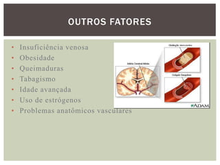 OUTROS FATORES

•   Insuficiência venosa
•   Obesidade
•   Queimaduras
•   Tabagismo
•   Idade avançada
•   Uso de estrógenos
•   Problemas anatômicos vasculares
 