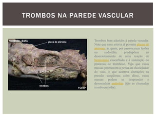 TROMBOS NA PAREDE VASCULAR


                Trombos bem aderidos à parede vascular.
                Note que essa artéria já possuía placas de
                ateroma, as quais, por provocarem lesões
                no     endotélio,      predispõem       ao
                desecadeamento de uma reação de
                hemostasia exacerbada e à instalação do
                processo de trombose. Veja que essas
                massas promovem a perda da elasticidade
                do vaso, o que acarreta alterações na
                pressão sangüínea; além disso, essas
                massas podem se desprender e
                desencadear embolias (são as chamadas
                tromboembolia).
 
