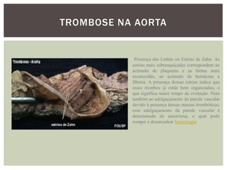 TROMBOSE NA AORTA


            Presença das Linhas ou Estrias de Zahn. As
           estrias mais esbranquiçadas correspondem ao
           acúmulo de plaquetas e as linhas mais
           escurecidas, ao acúmulo de hemáceas e
           fibrina. A presença dessas estrias indica que
           esses trombos já estão bem organizados, o
           que significa maior tempo de evolução. Note
           também ao adelgaçamento da parede vascular
           devido à presença dessas massas trombóticas;
           esse adelgaçamento da parede vascular é
           denominado de aneurisma, o qual pode
           romper e desencadear hemorragia
 