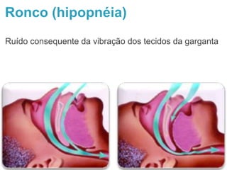 Ronco (hipopnéia)
Ruído consequente da vibração dos tecidos da garganta
 