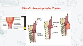 Divertículos por pulsão: Zenker
10
 