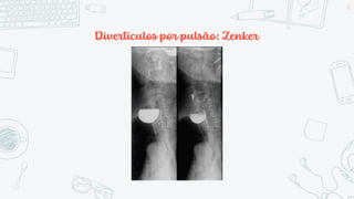 Divertículos por pulsão: Zenker
11
 