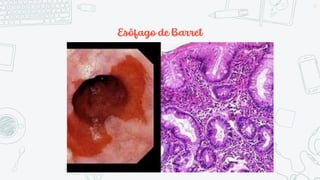Esôfago de Barret
57
 
