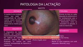 PATOLOGIA DA LACTAÇÃO
MASTITE
DEFINIÇÃO
A mastite é uma condição inflamatória da
mama, que pode ou não ser
acompanhada de infecção. Quando a
mastite ocorre durante o período de
aleitamento é chamada de mastite
lactacional ou mastite puerperal. (Zugaib,
2012)
ETIOLOGIA
A remoção ineficiente de leite em razão
de técnicas inadequadas de aleitamento é
o principal fator predisponente para a
instalação do quadro de mastite. Assim, a
suspensão do aleitamento, como se
acreditava ser necessária no passado, é
hoje contraindicada na maioria dos
casos
DIAGNÓSTICO
TRATAMENTO
O diagnostico de mastite e clinico,
podendo ser complementado com
exames bacteriológicos e de imagem.
Na vigência de mastite, a paciente
apresenta queixas de dor mamaria
localizada, na maioria das vezes
unilateral, acompanhada de hiperemia e
hipertermia
 Antibioticoterapia;
 Esvaziamento das mamas;
 Bolsa de gelo;
 Manter os seios suspensos com sutiã
adequados. (Rezende, 2015)
(Fonte :Zugaib, 2012)
 