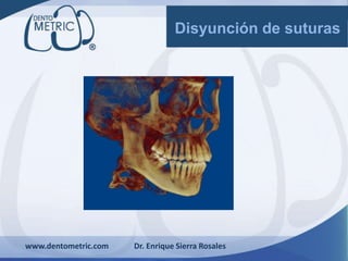 www.dentometric.com Dr. Enrique Sierra Rosales
Disyunción de suturas
 