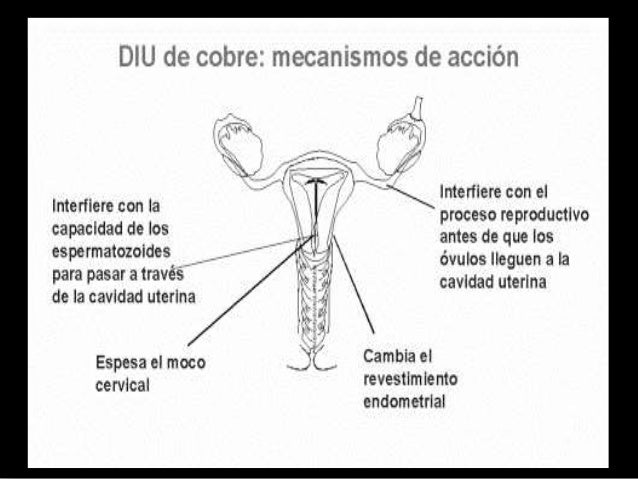 Dispositivo Intrauterino DIU