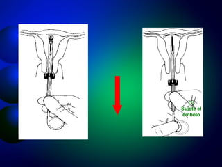 (1) Sujete el émbolo 