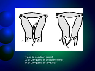 Tipos de expulsión parcial. A: el DIU queda en el cuello uterino. B: el DIU queda en la vagina 