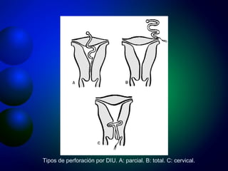 Tipos de perforación por DIU. A: parcial. B: total. C: cervical. 