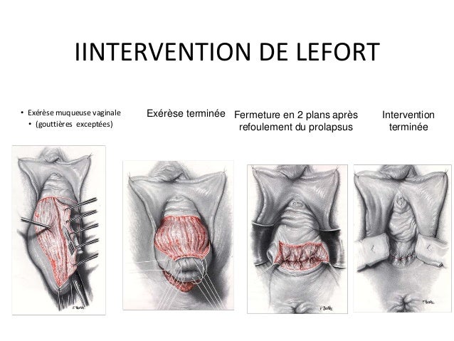 Diu gynecologie médicale rennes partie 1