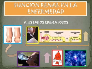 A. ESTADOS EDEMATOSOS
 