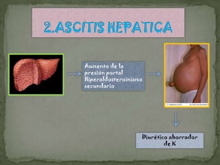 Aumento de la
presión portal
Hiperaldosteroinismo
secundario




                   Diurético ahorrador
                           de K
 