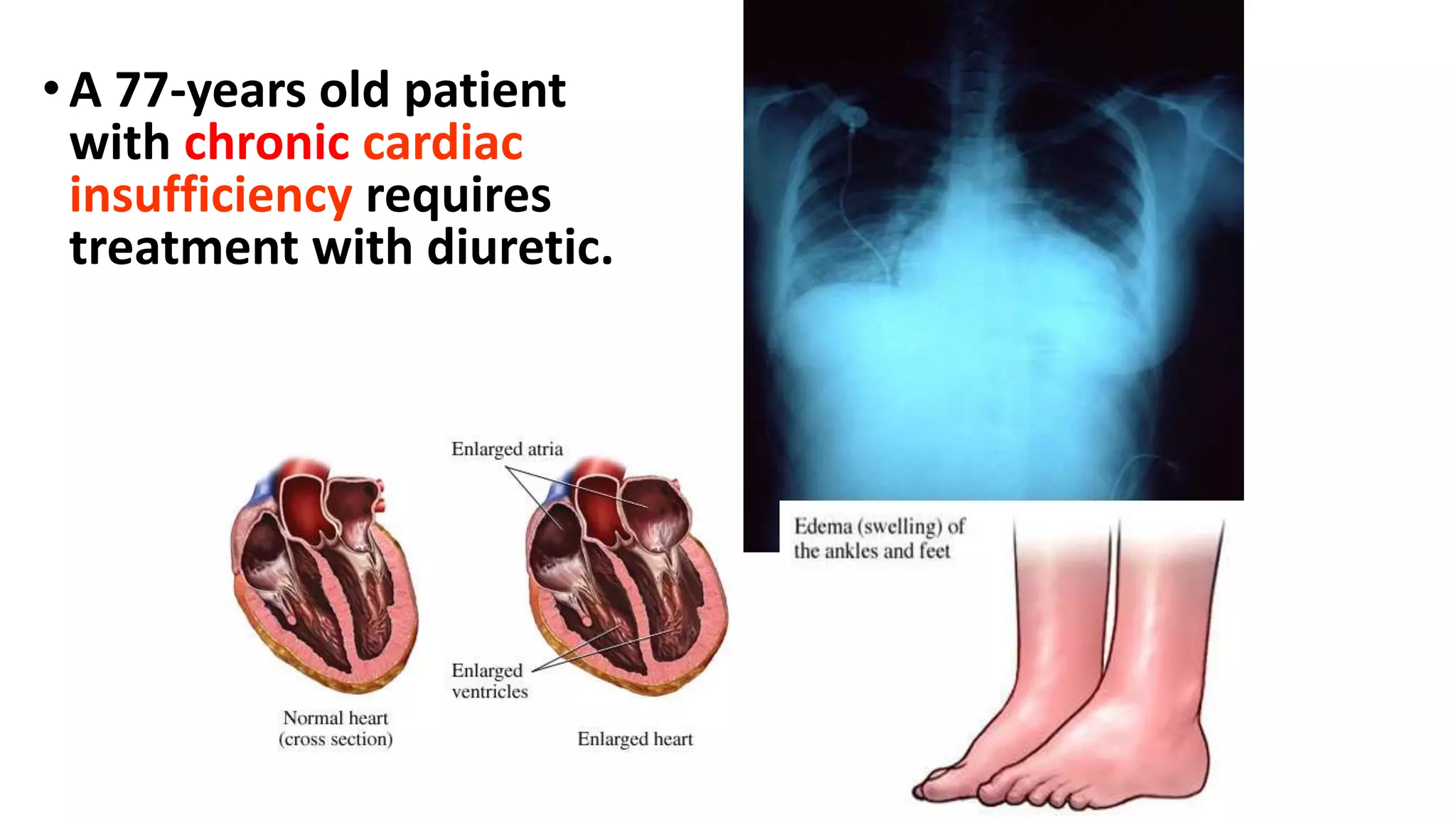 •A 77-years old patient
with chronic cardiac
insufficiency requires
treatment with diuretic.
 