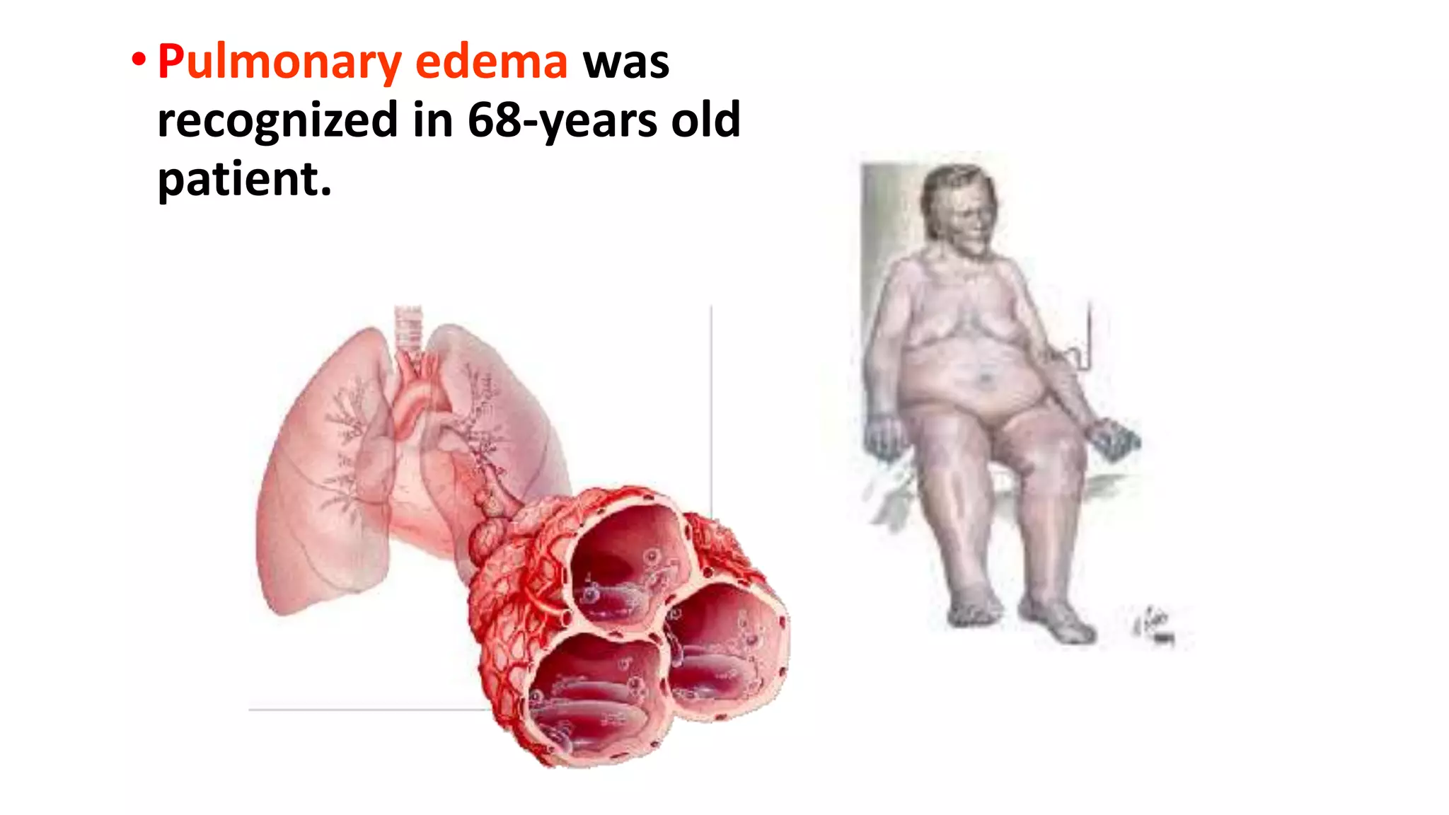 • Pulmonary edema was
recognized in 68-years old
patient.
 