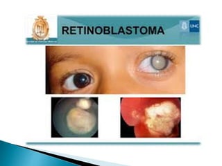 Exodeviations , Exotropia | PPTX